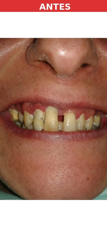 Paciente antes del implante dental Palomeras