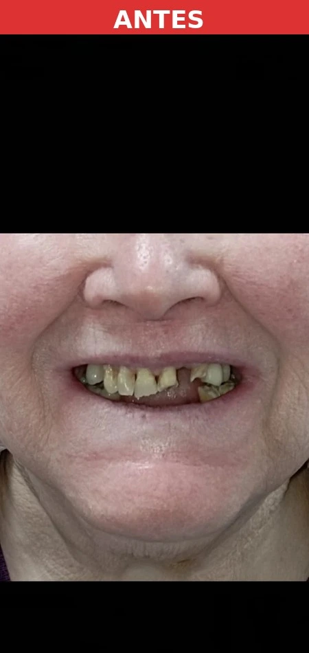 Paciente antes del implante dental Vallecas