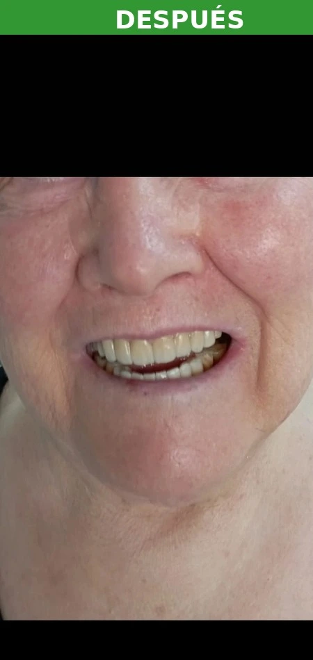 Resultado implante dental Vallecas — después