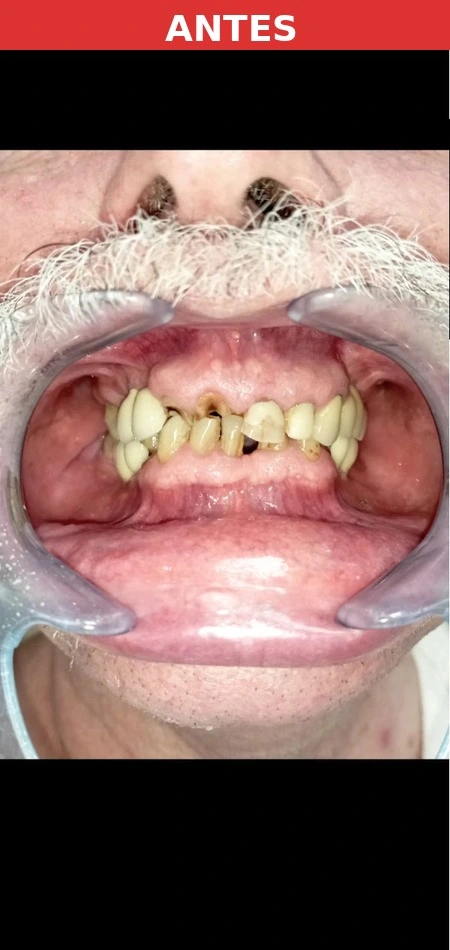 Paciente antes del implante dental Puente de Vallecas