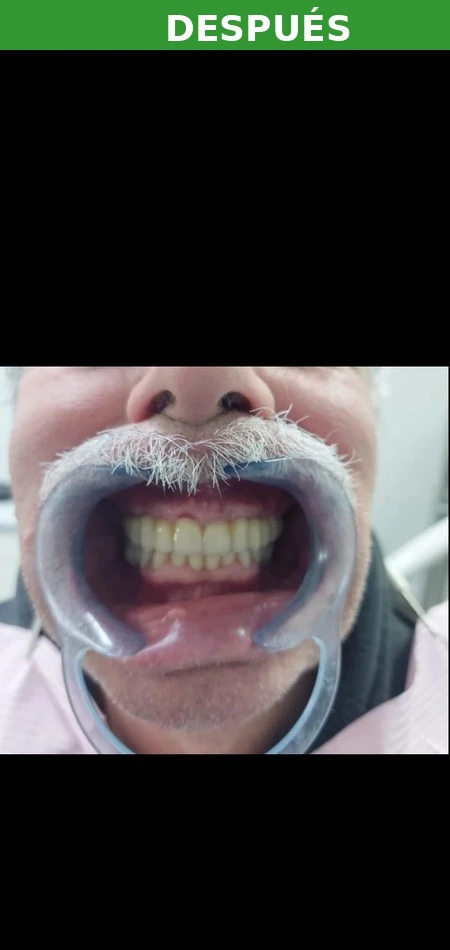 Resultado implante dental Puente de Vallecas — después